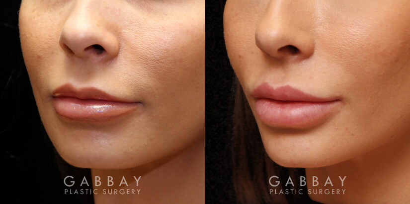 Patient 02 3/4th Left Side View Lip Augmentation Gabbay Plastic Surgery