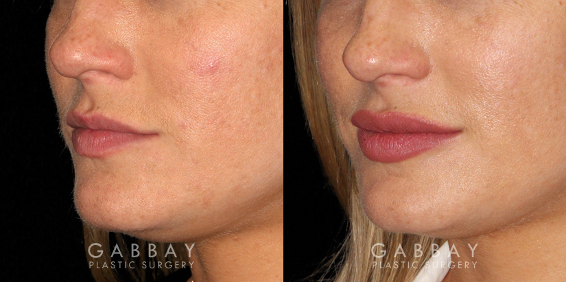 Patient 03 3/4th Left Side View Lip Augmentation Gabbay Plastic Surgery