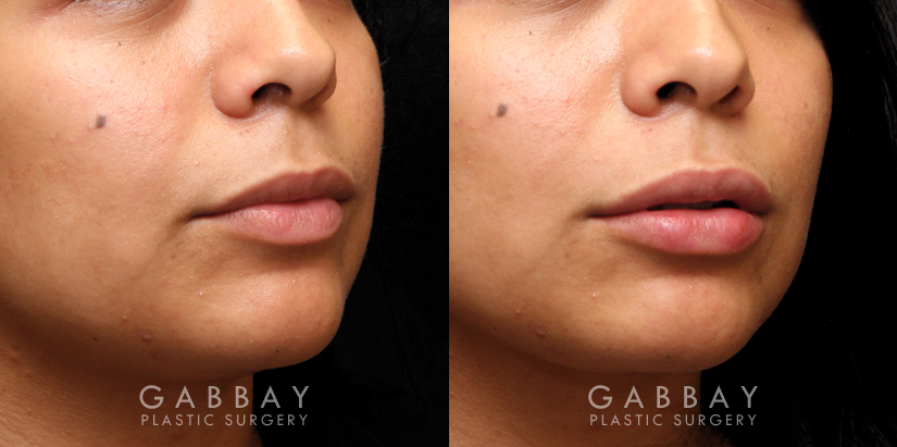 Patient 04 3/4th Right Side View Lip Augmentation Gabbay Plastic Surgery