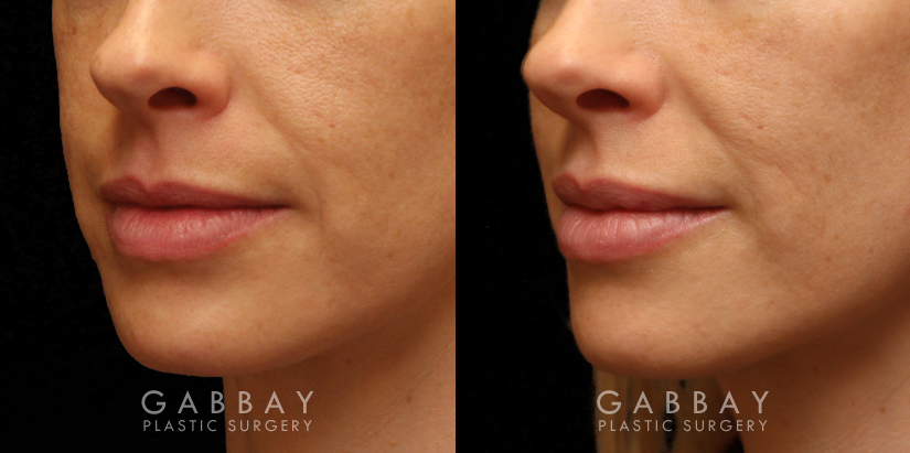 Patient 05 3/4th Left Side View Lip Augmentation Gabbay Plastic Surgery