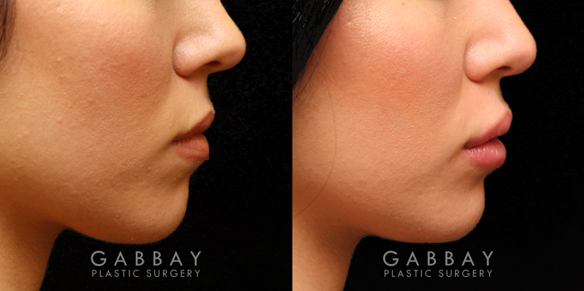 Patient 07 Right Side View Lip Augmentation Gabbay Plastic Surgery