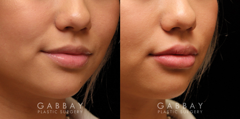 Patient 06 3/4th Right Side View Lip Augmentation Gabbay Plastic Surgery