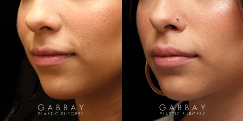 Patient 13 3/4th Left Side View Lip Augmentation Gabbay Plastic Surgery