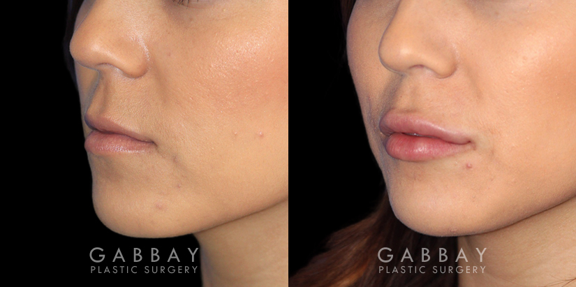 Patient 08 3/4th Left Side View Lip Augmentation Gabbay Plastic Surgery