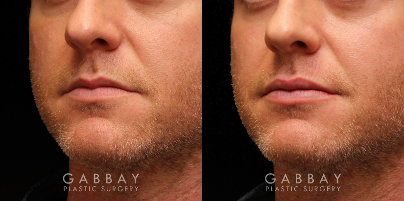 Patient 10 3/4th Left Side View Lip Augmentation Gabbay Plastic Surgery