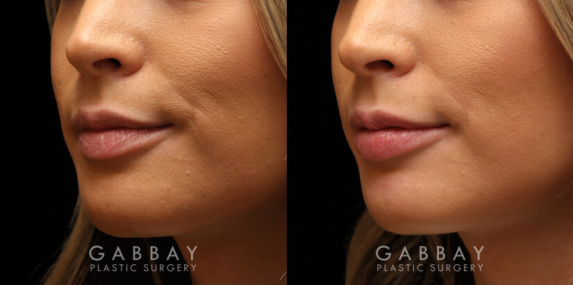 Patient 11 3/4th Left Side View Lip Augmentation Gabbay Plastic Surgery