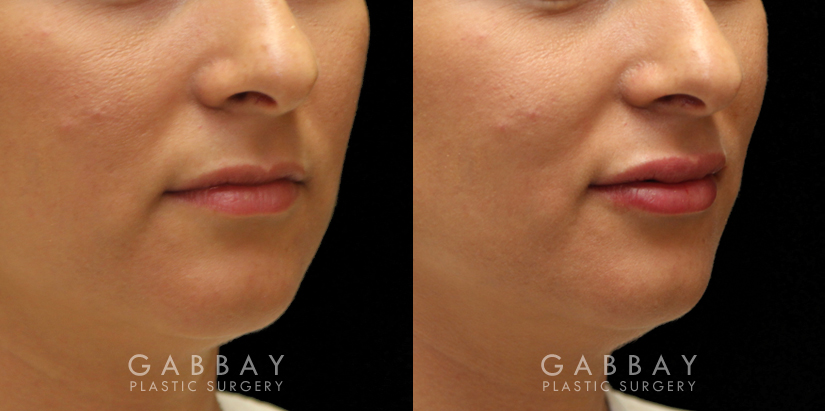 Patient 09 3/4th Right Side View Lip Augmentation Gabbay Plastic Surgery