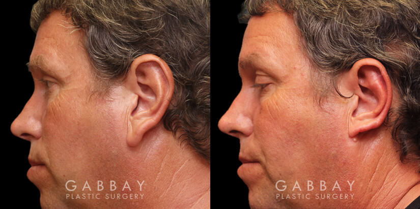 Patient 01 Left Side View Ear reduction Gabbay Plastic Surgery