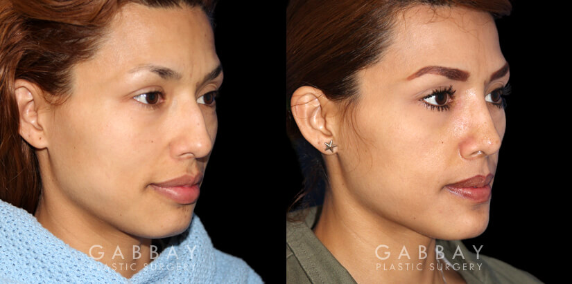 Patient 01 3/4th Right Side View Rhinoplasty Gabbay Plastic Surgery