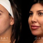 Patient 02 3/4th Left Side View Buccal Fat Pad Removal Gabbay Plastic Surgery