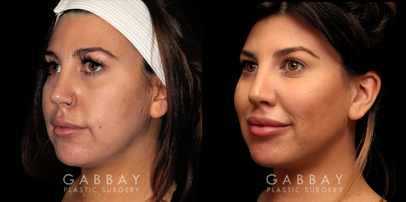 Patient 02 3/4th Left Side View Buccal Fat Pad Removal Gabbay Plastic Surgery