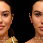 Buccal Fat Pad Removal Before and After | Patient 03 Front View | Gabbay Plastic Surgery