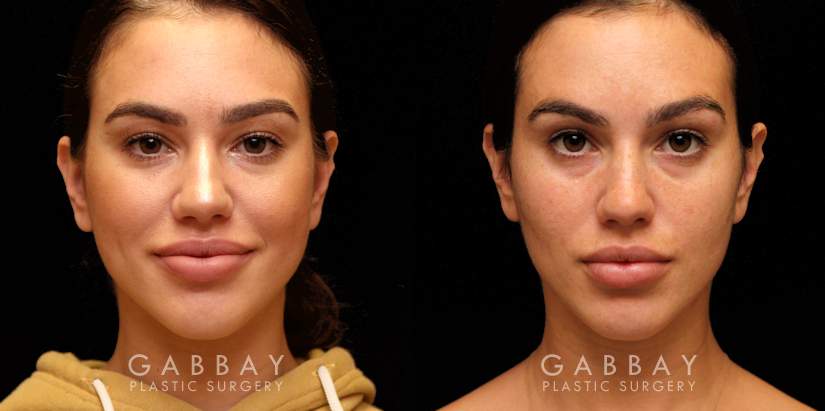 Buccal Fat Pad Removal Before and After | Patient 03 Front View | Gabbay Plastic Surgery