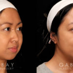 Patient 05 3/4th Right Side View Buccal Fat Pad Removal Gabbay Plastic Surgery