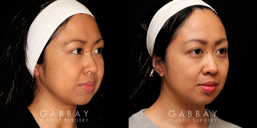 Patient 05 3/4th Right Side View Buccal Fat Pad Removal Gabbay Plastic Surgery