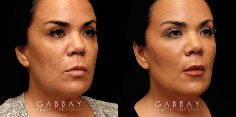 Patient 11 3/4th Right Side View Buccal Fat Pad Removal Gabbay Plastic Surgery