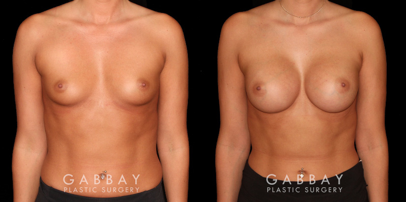 Patient results for breast augmentation. Note the rounded shape and lack of visible scarring. Patient’s recovery was smooth, absent of complications.