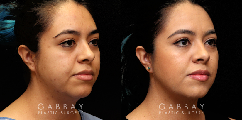 Patient 10 3/4th Right Side View Buccal Fat Pad Removal Gabbay Plastic Surgery