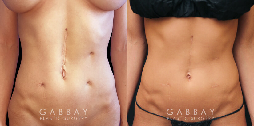 Patient 01 Front View Scar Revision Before and After Gabbay Plastic Surgery