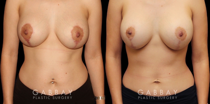Patient 03 Front View Scar Revision to Breasts Gabbay Plastic Surgery