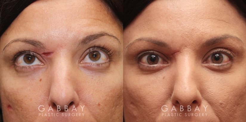 Patient 02 Front View Scar Revision to Eyebrow Gabbay Plastic Surgery