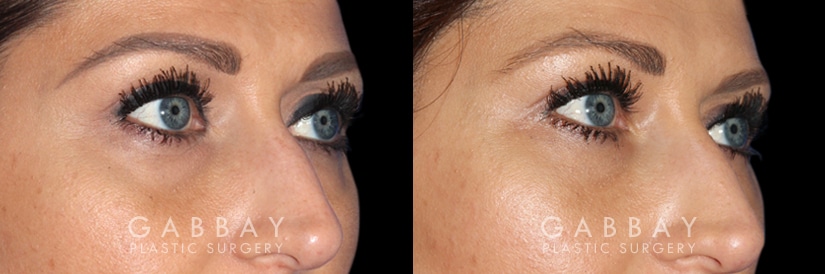 Patient 02 3/4th Right Side View Upper Eyelid Blepharoplasty with Fat Transfer to Face Gabbay Plastic Surgery