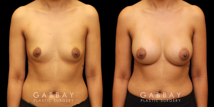 Before and after silicone implants for female patient. Her breast augmentation went smoothly and the recovery was without complications.