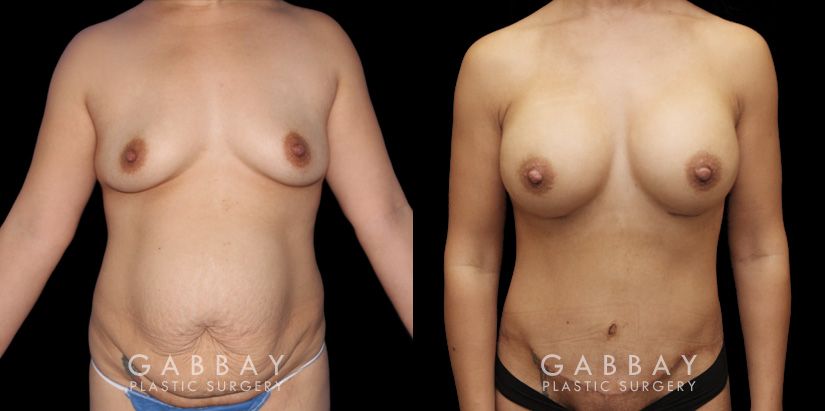 Patient with combination procedure that included breast augmentation with silicone implants, pubis lift, and scar revision for a smoother, refined final result.