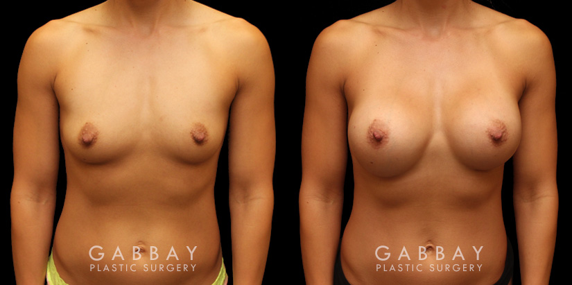 Patient photos showing before and after her breast augmentation procedure, with notable breast size increase while maintaining a balanced aesthetic.