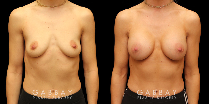 Silicone breast augmentation results after full recovery. Multi-angle view shows the boost to volume from each side for an alluring profile.