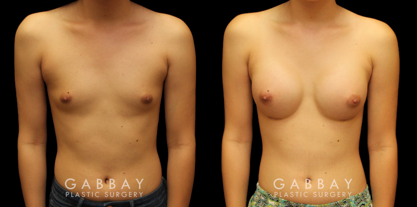 Patient results from breast augmentation, showing the increase from minimal breast size to a round, fuller appearance that suits her body shape.