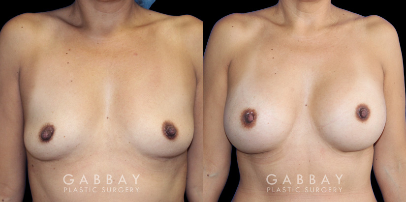Breast augmentation results including silicone implant augmentation combined with tummy tuck and flank liposuction. The final result is a tightened body contour with enhanced breast size.