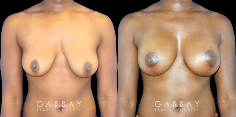 Silicone breast augmentation before-and-after photos demonstration enhanced breast size. Patient combined augmentation with a breast lift for improved breast position as well.