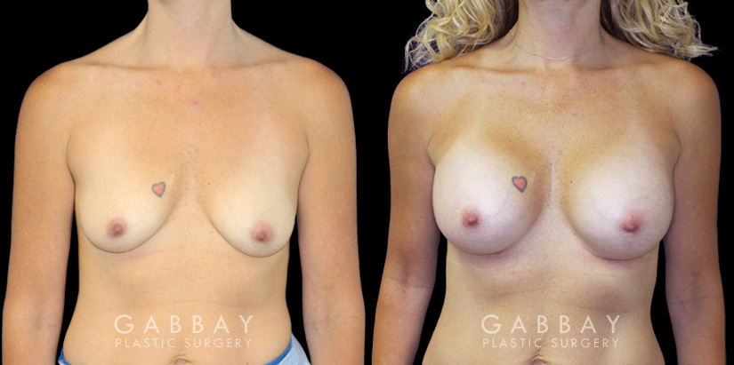 Patient in her mid 40s following breast augmentation. Before-and-after photos show her fully healed results from each angle, demonstrating the improved breast volume.