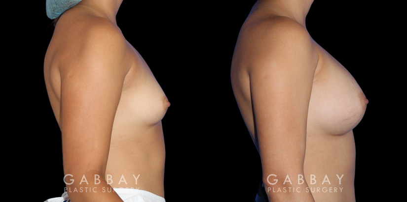 Photos showing patient following complete recovery from breast augmentation with silicone implants. Breast volume increased from minimal size to full, refined volume.