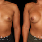 This is a young woman with a tuberous or constricted breast deformity. The lower portion of the breast developed more tightly than the rest of the breast. She wanted a more full, but natural breast appearance. She had silicone breast augmentation, with placement of an Allergan naturelle soft touch silicone breast implant through a lower breast/inframammary fold incision. Her moderate profile implants were 310 cc. Patients like this are prone to lower breast complications such as a double bubble, but with careful performance of the operation, she easily avoided this complication.