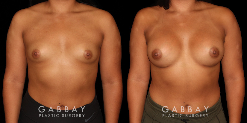 This is a young woman with a tuberous or constricted breast deformity. The lower portion of the breast developed more tightly than the rest of the breast. She wanted a more full, but natural breast appearance. She had silicone breast augmentation, with placement of an Allergan naturelle soft touch silicone breast implant through a lower breast/inframammary fold incision. Her moderate profile implants were 310 cc. Patients like this are prone to lower breast complications such as a double bubble, but with careful performance of the operation, she easily avoided this complication.