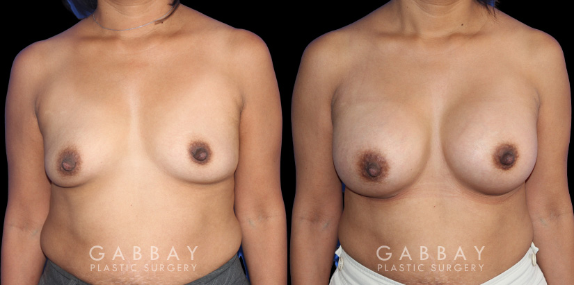 Patient before and after silicone implants with complete, uncomplicated recovery. Volume increase is notable while also improving the balance between breasts without resorting to unnatural perfect symmetry.