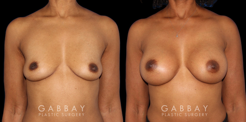 Before-and-after photos for saline implant breast augmentation patient. Her implant choice allowed for more natural shape and slope to the breasts, most notable in the profile view.