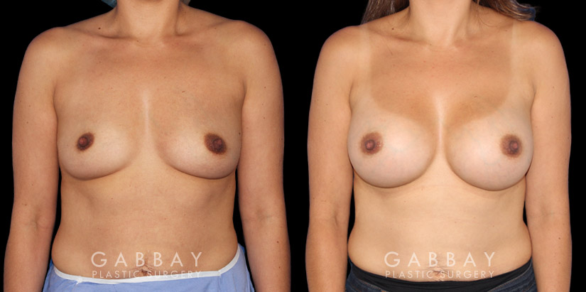 Silicone implants used to increase breast volume while keeping a natural shape. Patient healed well with no complications.