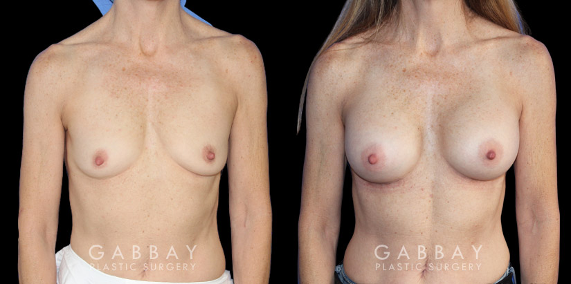 Female patient in her late 40s with breast augmentation results using silicone implants. Patient healed well and achieved a breast size and appearance that enhances a youthful contour and appearance.