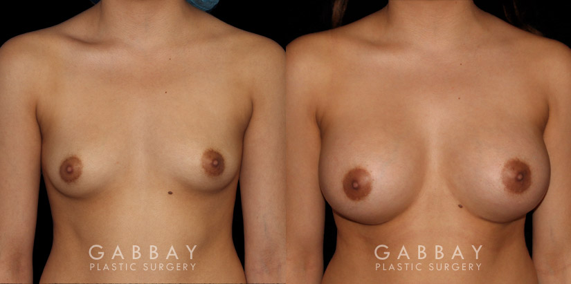 Breast augmentation patient results with silicone implants after fully healed. Breast size increased by multiple cups while keeping a natural balance between breast size and the patient’s body type.