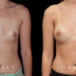 Before and after silicone breast implants for breast augmentation. Note the natural slope to the breasts and the symmetrical appearance while still increasing overall size.