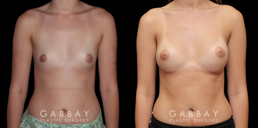 Before and after silicone breast implants for breast augmentation. Note the natural slope to the breasts and the symmetrical appearance while still increasing overall size.