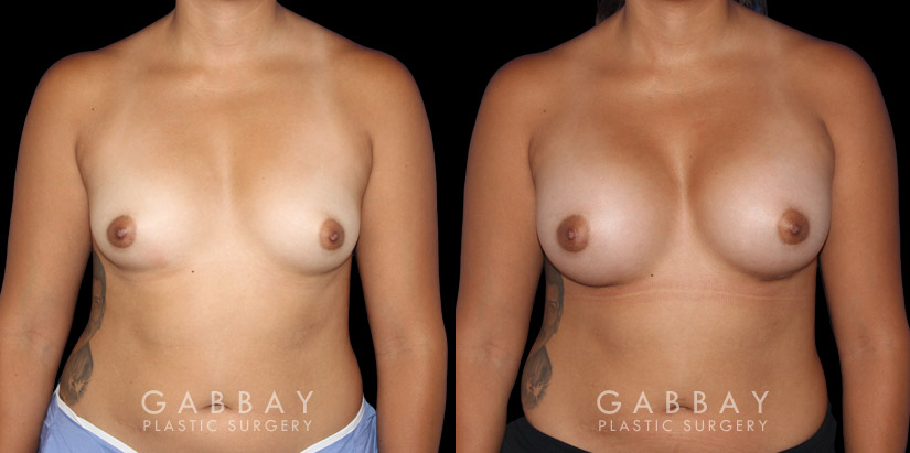 Breast Augmentation before-and-after photos demonstrating increased breast volume using silicone implants. Patient sought a milder increase to bust while keeping the volume within a natural range.