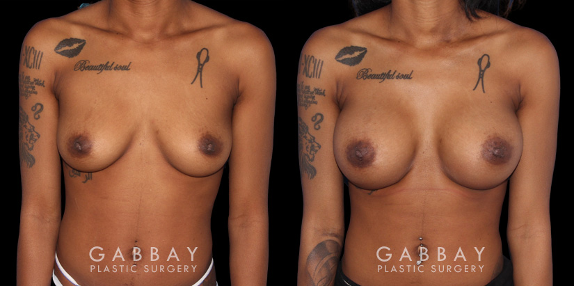 Patient with significant breast volume increase through breast augmentation with silicone implants. Profile view demonstrates the enhanced breast size by silhouette with an alluring, round shape.