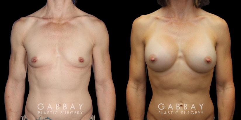 Breast augmentation results for patient with slim and fit body type. The silicone implants were chosen to match this tighter physique for a natural balance.