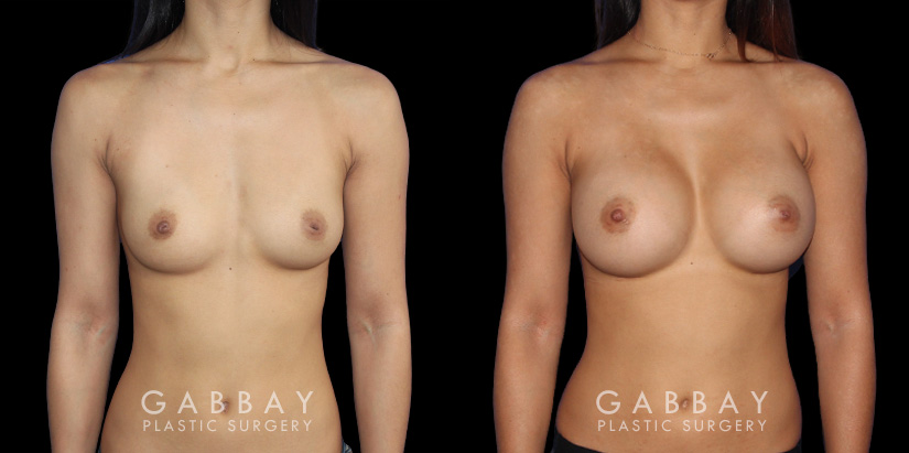 Before-and-after photos for breast augmentation showing fully recovered patient. Note the lack of visible scarring despite the dramatic increase to bust volume. Balanced, round breast shape enhances the patient’s natural figure.