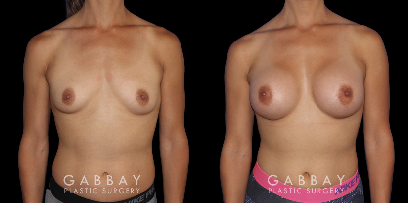 Patient recovered without complication and maintained a round, pleasing shape to her breasts. Scarring is hidden in the breasts natural folds, displaying only her positive results.