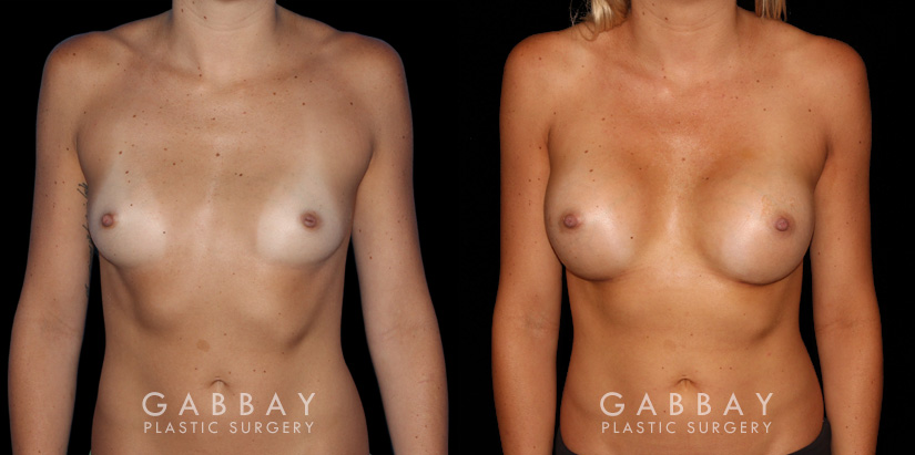 Breast augmentation before-and-after photos for patient with silicone implants. Increased volume resulted in pleasantly round breasts without excessive change.